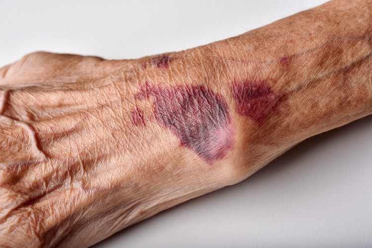 manchas-moradas-en-la-piel-en-ancianos